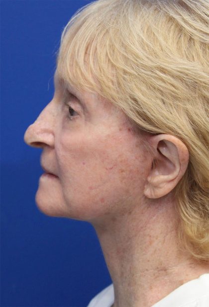 Facelift Before & After Patient #5279