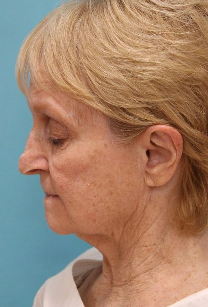 Facelift Before & After Patient #5279