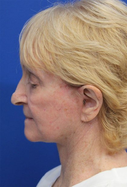Facelift Before & After Patient #5279