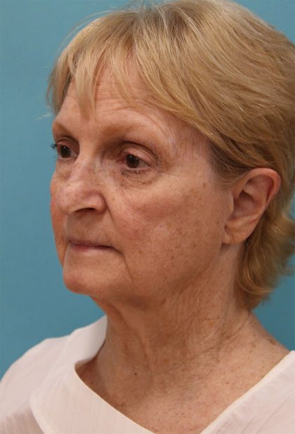 Facelift Before & After Patient #5279