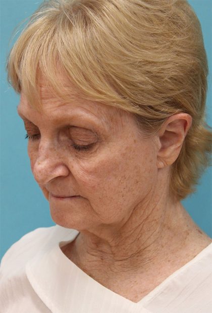 Facelift Before & After Patient #5279