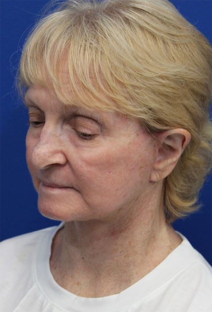 Facelift Before & After Patient #5279