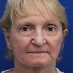 Facelift Before & After Patient #5279