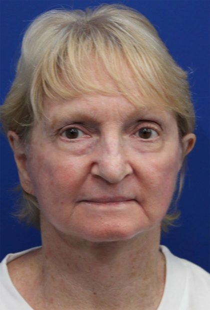 Facelift Before & After Patient #5279