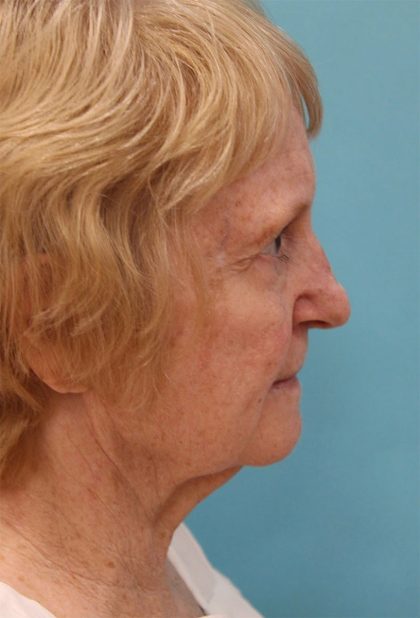 Facelift Before & After Patient #5279