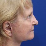 Facelift Before & After Patient #5279