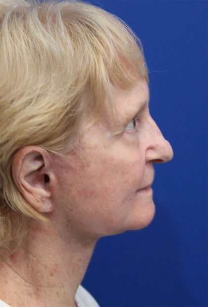 Facelift Before & After Patient #5279