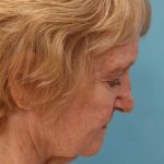 Facelift Before & After Patient #5279