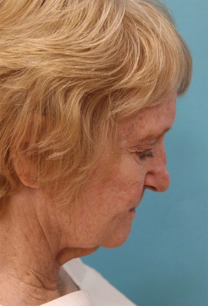 Facelift Before & After Patient #5279