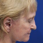 Facelift Before & After Patient #5279