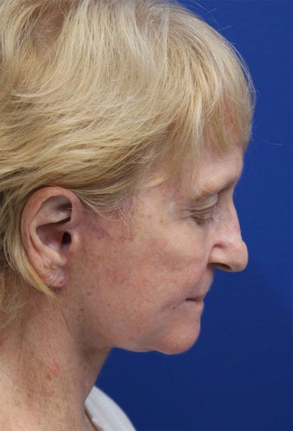 Facelift Before & After Patient #5279