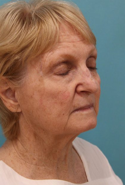 Facelift Before & After Patient #5279