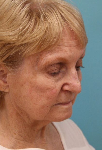 Facelift Before & After Patient #5279