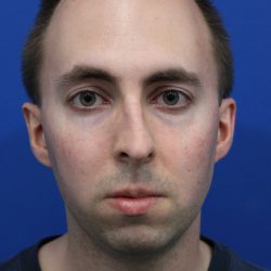 Deep Neck Lift Before & After Patient #5479