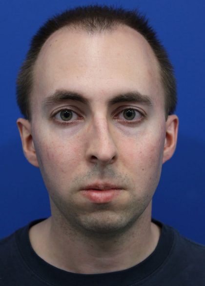 Deep Neck Lift Before & After Patient #5479