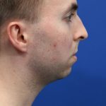 Chin Implant Before & After Patient #5498
