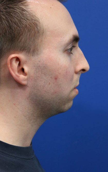 Deep Neck Lift Before & After Patient #5479