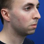 Chin Implant Before & After Patient #5498