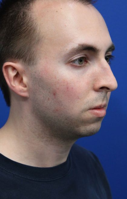 Deep Neck Lift Before & After Patient #5479