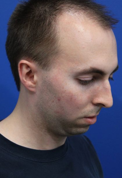 Deep Neck Lift Before & After Patient #5479