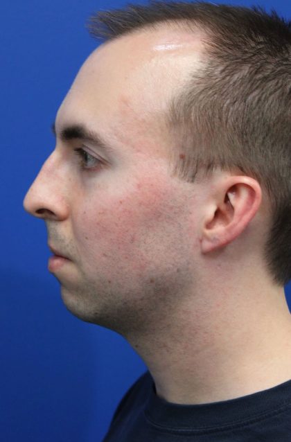 Deep Neck Lift Before & After Patient #5479