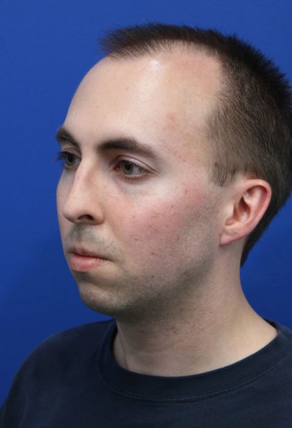 Deep Neck Lift Before & After Patient #5479