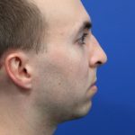Chin Implant Before & After Patient #5498