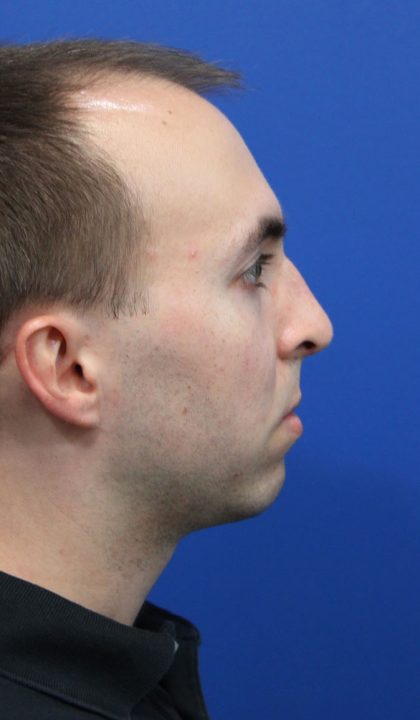 Deep Neck Lift Before & After Patient #5479