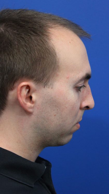 Deep Neck Lift Before & After Patient #5479