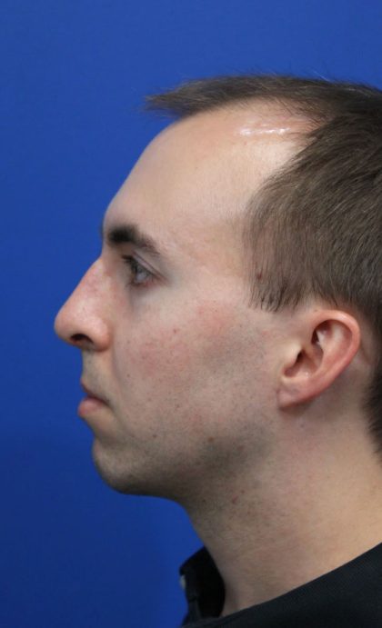 Deep Neck Lift Before & After Patient #5479