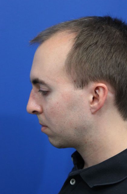 Deep Neck Lift Before & After Patient #5479