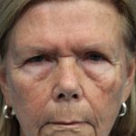 Brow Lift Before & After Patient #5424