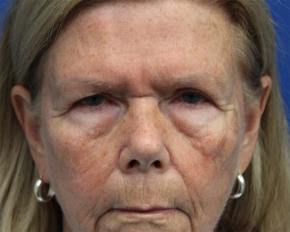 Brow Lift Before & After Patient #5424