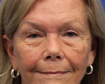 Brow Lift Before & After Patient #5424