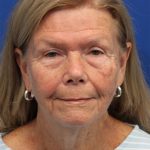 Facelift Before & After Patient #5425