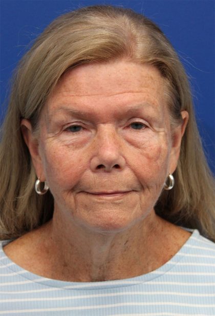 Facelift Before & After Patient #5425