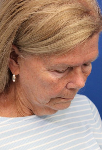 Facelift Before & After Patient #5425