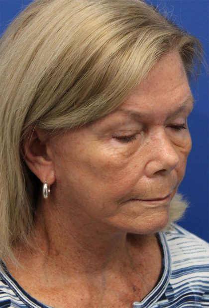 Facelift Before & After Patient #5425