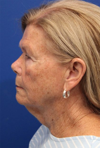 Facelift Before & After Patient #5425