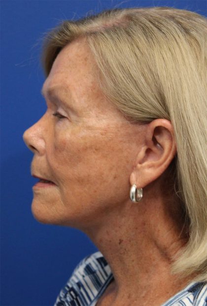 Facelift Before & After Patient #5425