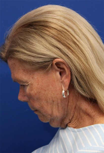 Facelift Before & After Patient #5425