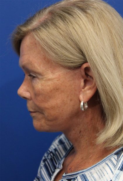 Facelift Before & After Patient #5425