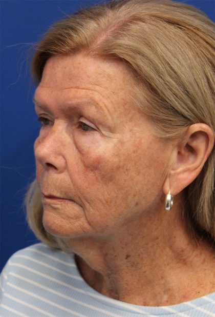 Facelift Before & After Patient #5425