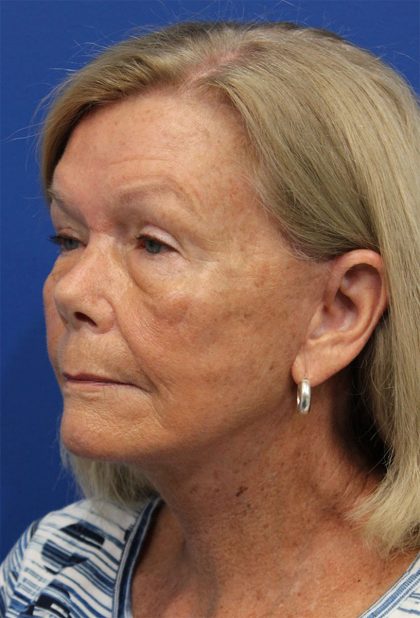 Facelift Before & After Patient #5425