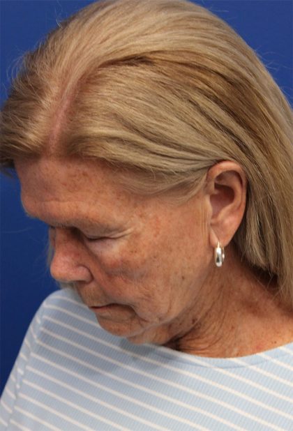 Facelift Before & After Patient #5425