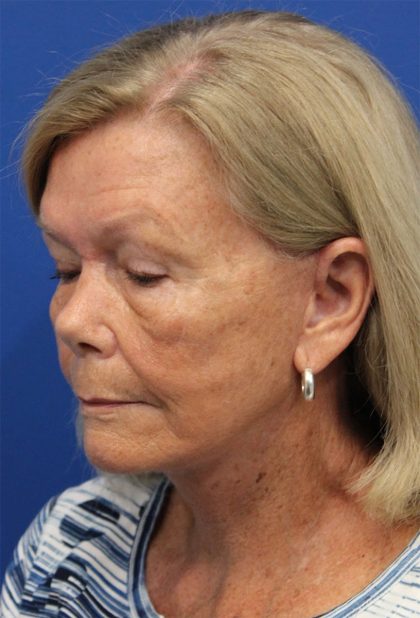 Facelift Before & After Patient #5425