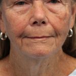 Facelift Before & After Patient #5425