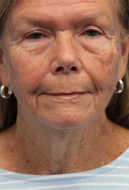 Facelift Before & After Patient #5425