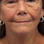 Facelift Before & After Patient #5425