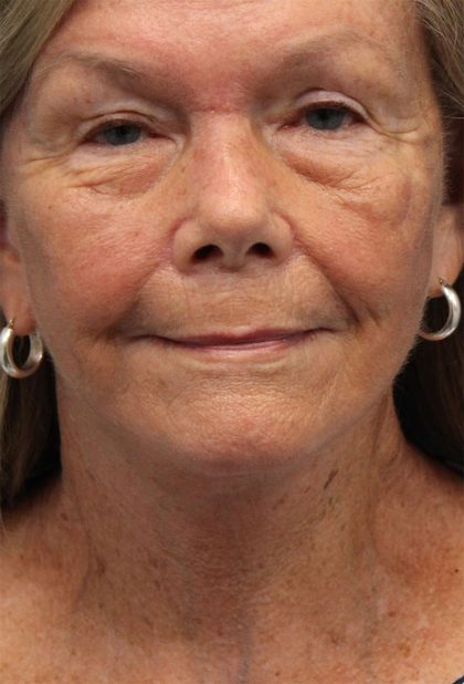 Facelift Before & After Patient #5425
